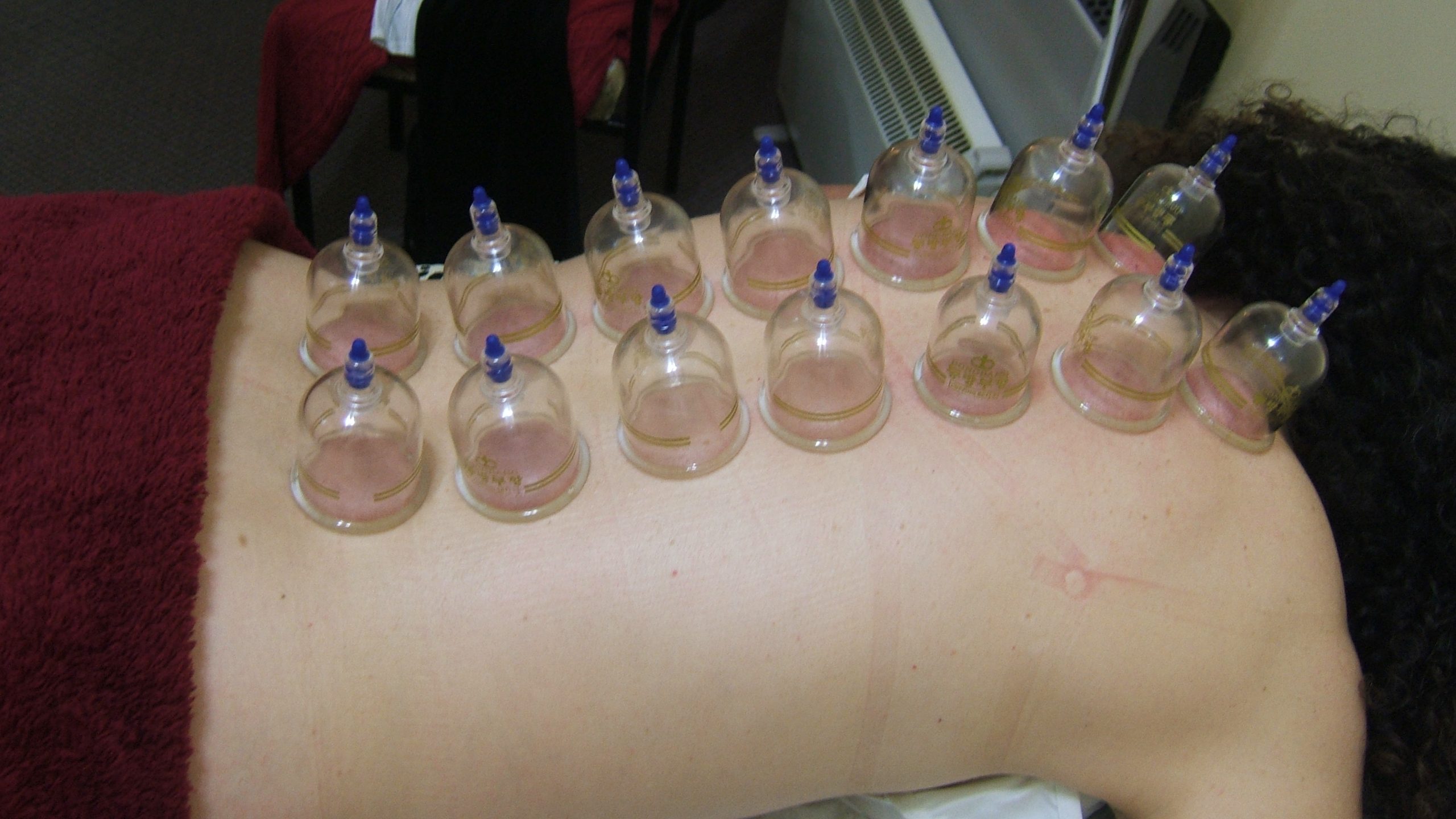 Cupping Photo
