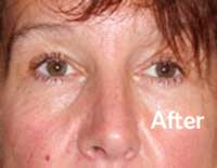 After Cosmetic Acupuncture