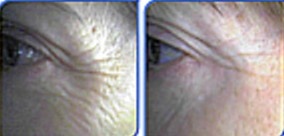 Before and After