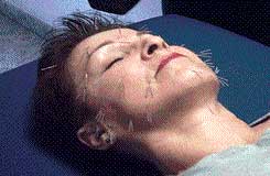 Facial-Acupuncture-