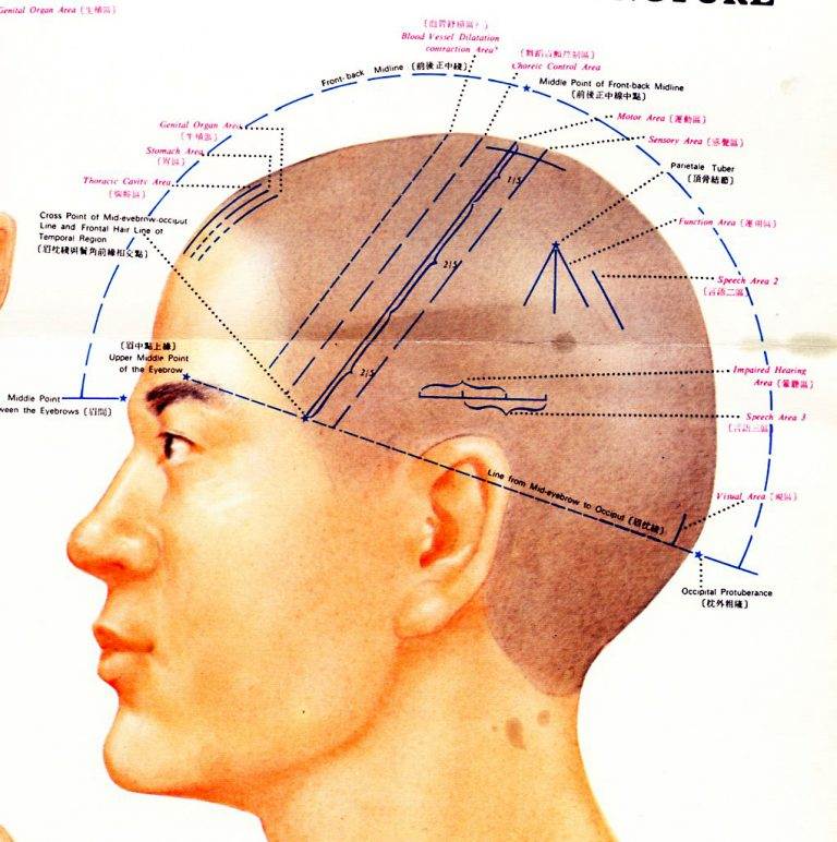 Scalp Acupuncture
