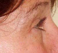 After Cosmetic Acupuncture