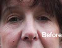 Before Cosmetic Acupuncture 2