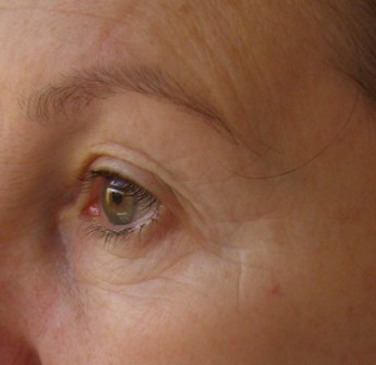 Before Cosmetic Acupuncture