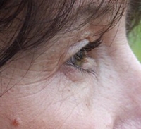 Before Cosmetic Acupuncture