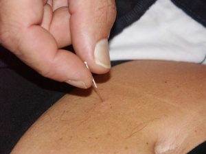 Traditional Chinese Medicine Acupuncture in tummy