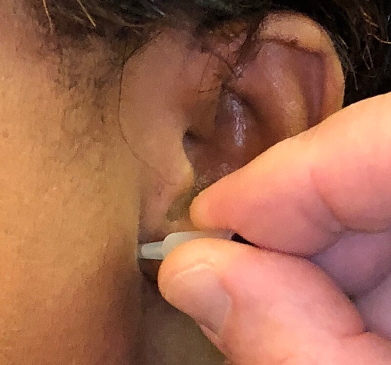 Ear Acupuncture